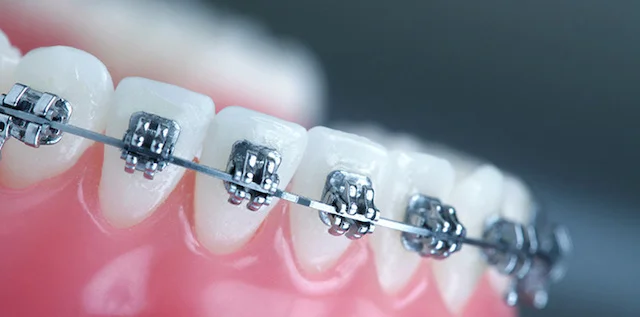 Les étapes d'un traitement orthodontique